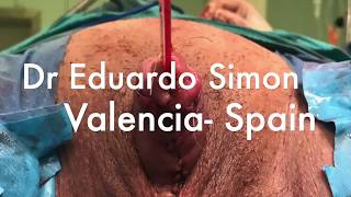 Metaidoplastia Dr Eduardo Simon (Valencia-SPAIN)