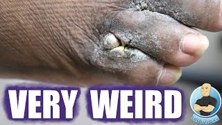 WEIRD GROWTH IN BETWEEN TOES ***ABNORMAL SKIN GROWTH***
