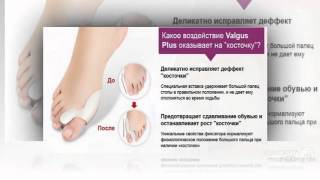 уникальный корректор valgus plus отзывы

  - Valgus Pro - Обзор Фиксатора