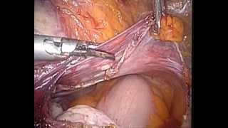 Classic TLH BSO. with Vaginal Vault Suspension, our technique of Lateral Approach