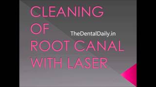 laser in dentistry- cleaning of root canal