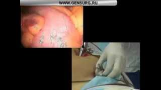 Лапароскопическая аппендэктомия.   Laparoscopic appendectomy