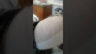 Big News! Transtibial Amputation part 2