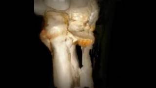 radial neck impacted fracture