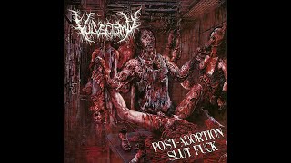 Vulvectomy - Adolescent Vaginal Gourmet