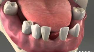Dentures ALternatives Full Arch