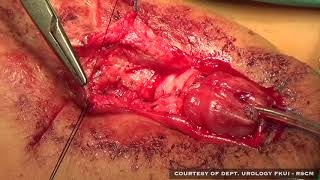 Cantwell-Ransley Epispadia Repair