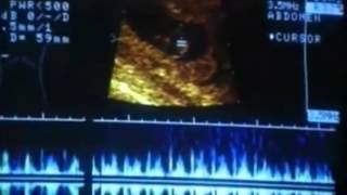 karından ultrasonda kese ne zaman görülür
