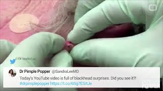 Dr. Pimple Popper Is Looking - (WARNING GRAPHIC)