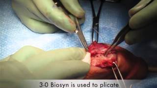 Peyronie's Disease Management - Dot Plication Surgical Management