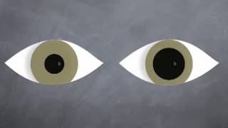 Anisocoria