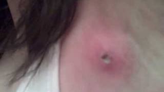 Really Bad Spider Bite