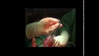 OBSTETRIC HYSTERECTOMYDr  PANICKER'S TECHNIQUE