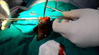 Penile Cancer in a case of operated Phimosis patient