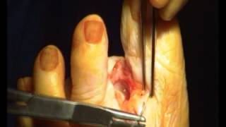 Toe Amputation