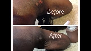 How To Deal With Amputee Pressure Sores!