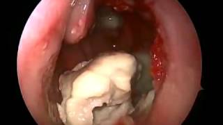 Фурункул в носу / Boil in the nose (18+)