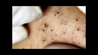 Новое выдавливание ПРЫЩЕЙ и ЧЕРНЫХ ТОЧЕК!  p20