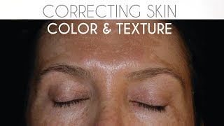 Lasers and Lights: Improving Skin Color and Texture