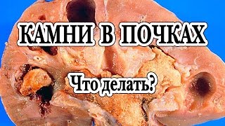 Камни в почках. Лечение коралловых камней.