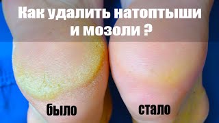 Как удалить натоптыши и мозоли со ступней ног лазерной теркой