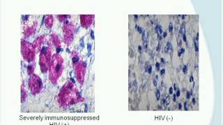 Tuberculosis: Pathogenesis and Transmission