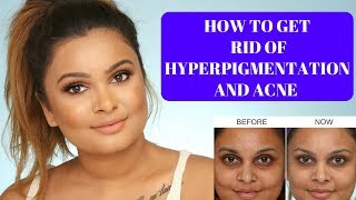 HOW TO GET RID OF HYPERPIGMENTATION & ACNE | SKINCARE FOR HYPERPIGMENTATION AND ACNE