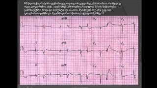 მოციმციმე არითმია და ჯგუფური ვენტრიკულური ექსტრასისტოლია / საგულე გლიკოზიდებით ინტოქსიკაცია