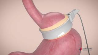 GastroCenter - Banda ou Anel Gástrico Ajustável