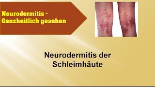 Neurodermitis der Schleimhäute - GANZMEDIZIN Naturheilpraxis