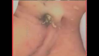 Новое выдавливание ПРЫЩЕЙ и ЧЕРНЫХ ТОЧЕК! Blackheads- Acne(Part 107)
