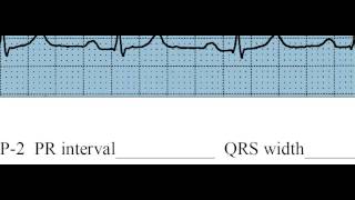 Chapter 1-2 Sinus Rhythms, Strip 2 (in class practice)