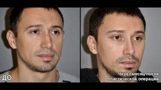 Эндоскопический лифтинг в клинике пластической хирургии MEDICI