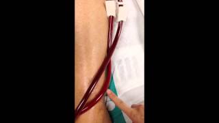 ECMO - Starting Sweep Gas