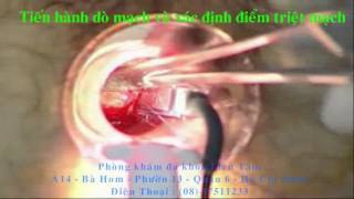 MỔ TRĨ SIÊU ÂM DOPPLER THD