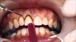 ตัดเหงือก แก้ยิ้มเห็นเหงือก / Gummy Smile Treatment by Gingivectomy