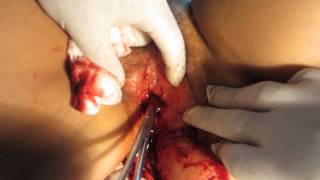 HIMENOPLASTIA