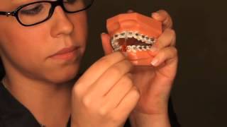 BU Orthodontics - Brushing And Flossing While Wearing Braces
