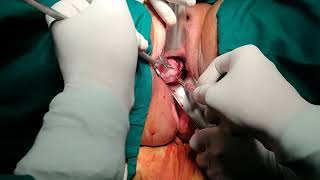 Lateral coaring technique for big size uterus after TLH