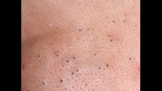 Удаление пинцетом черных точек на носу/Squeezing blackheads