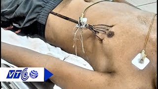 Quảng Ngãi: Cứu sống ngoạn mục bệnh nhân thủng tim | VTC