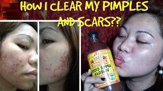 HOW I CLEAR MY PIMPLES,SCARS ,Darkspot USING APPLE CIDER VINEGAR
