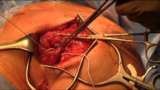 Pectoralis Major Tendon Repair: Brief Review and Surgical Technique