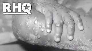 Sex Parties To Blame For Monkey Pox Outbreak