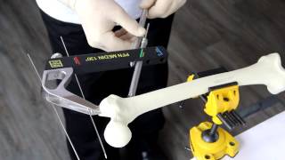 Proximal Femoral Nail MEDIN - basic operating procedure