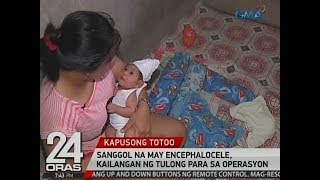 24 Oras: Sanggol na may encephalocele, kailangan ng tulong para sa operasyon
