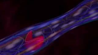 Sickle Cell Disease - What Causes Sickle Cell Disease Video - About.com.m4v