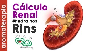 PEDRA NOS RÍNS -  #Tratamentos