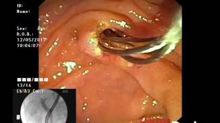 РХПГ (ERCP)