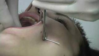 Piercing Both Sides of Cheeks
